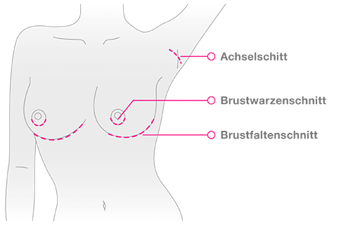 Brustvergrösserung